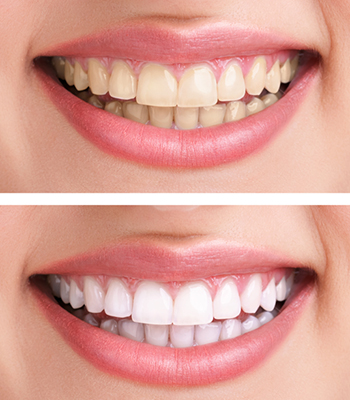 Antes-despues-Blog-Juárez-Blanqueamiento-Dental