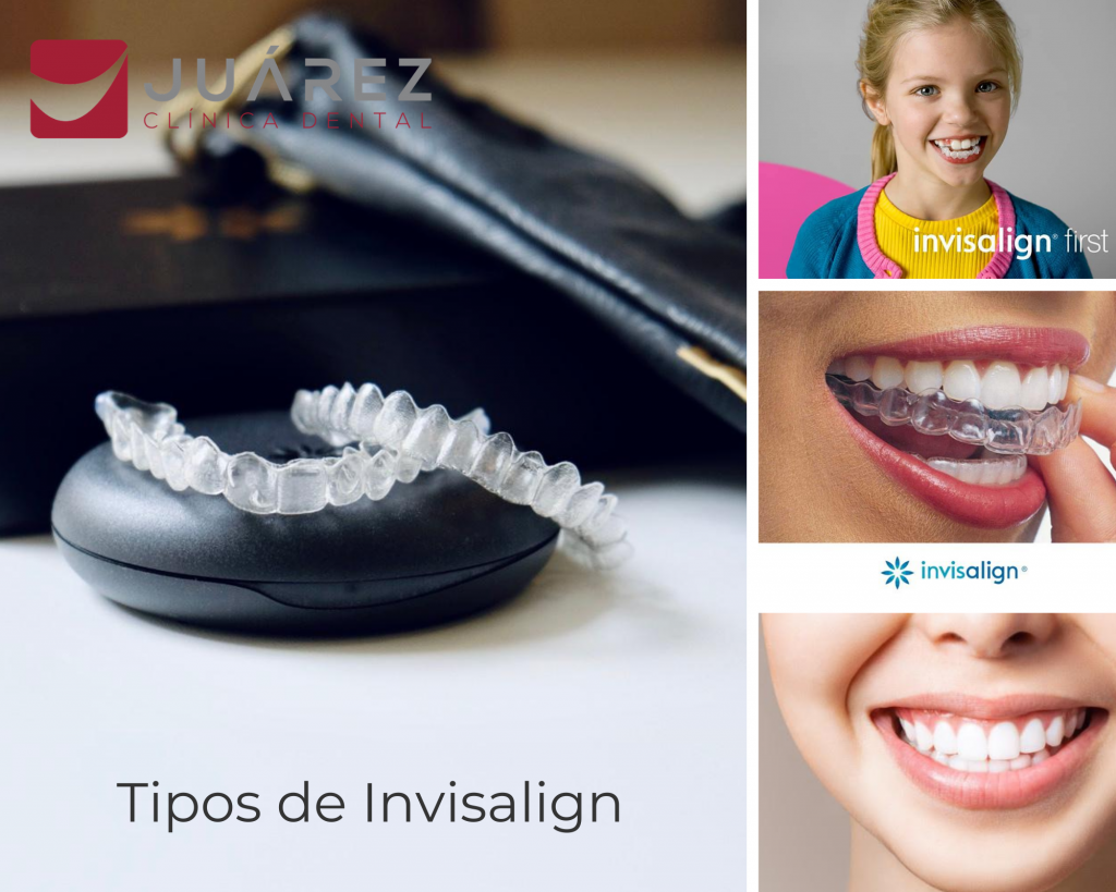 ¿Conoces Todos Los Tipos De Invisalign? – Juárez Clínica Dental